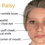 علائم فلج بلز