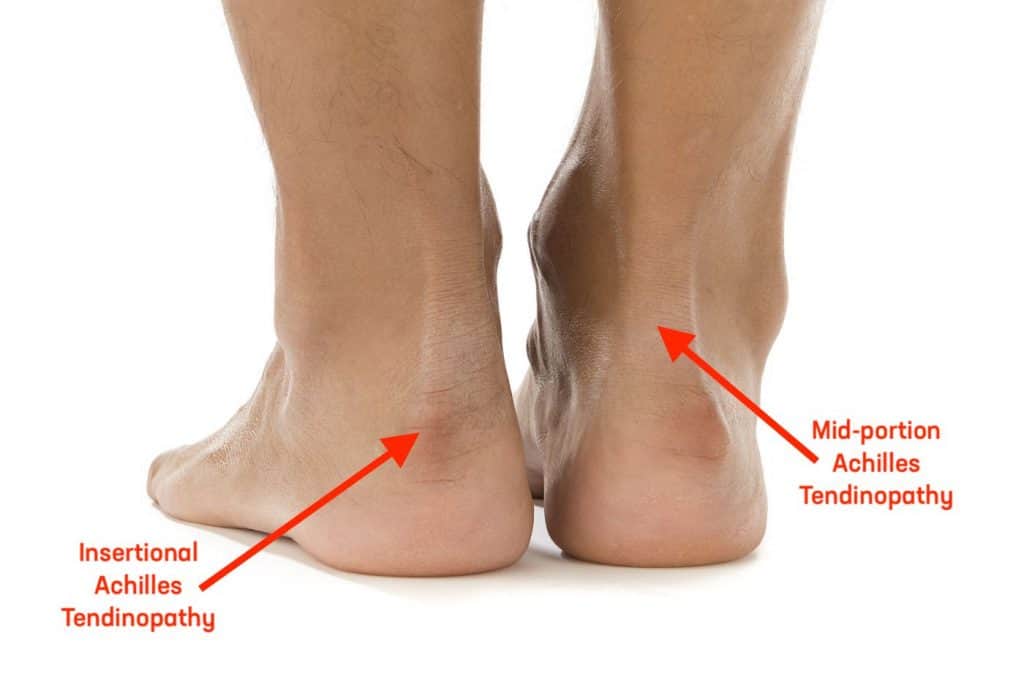 تاندینوپاتی آشیل (Achilles Tendinopathy)