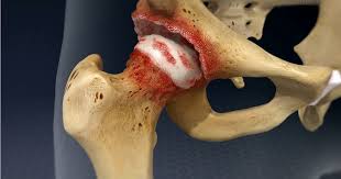 نکروز آواسکولار ( AVN)