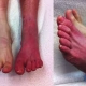 سندرم کمپارتمان (Compartment Syndrome)
