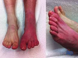 سندرم کمپارتمان (Compartment Syndrome)