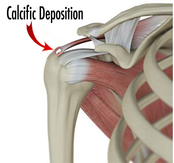 رسوب کلسیم در تاندون
