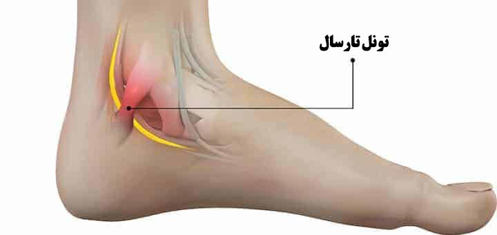 سندرم تونل تارسال(TS)