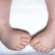 پای چنبری ( club foot)